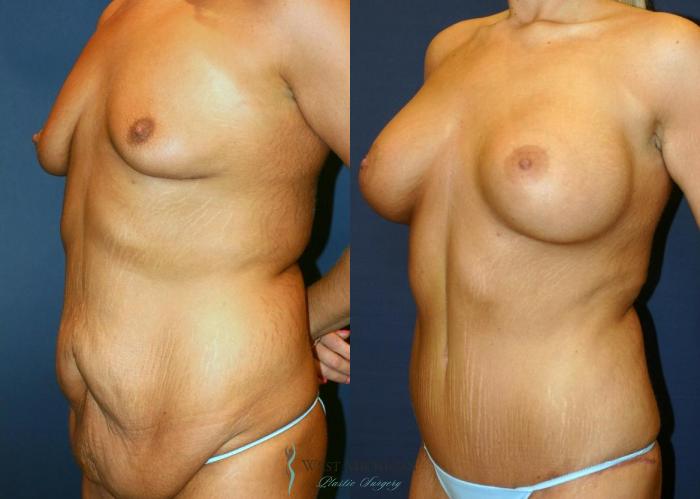 Before & After Post Weight Loss Case 9047 View #3 View in Kalamazoo & Grand Rapids, Michigan