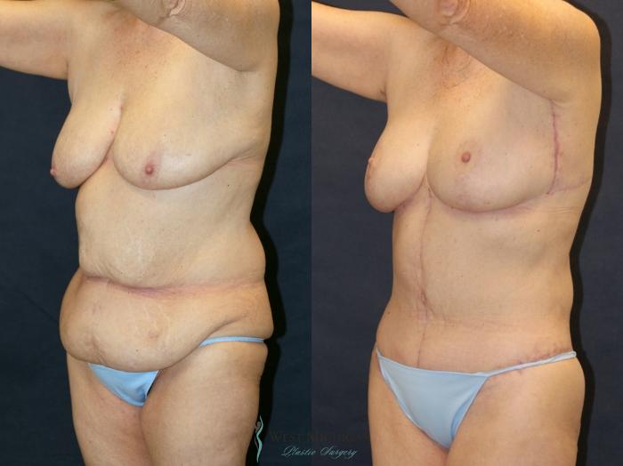 Before & After Breast Lift Case 9336 Left Oblique View in Portage, Kalamazoo, Battle Creek, Michigan