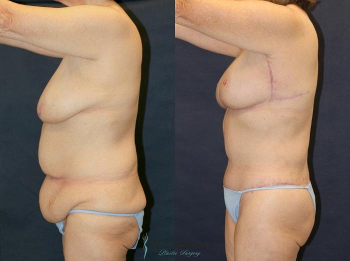 Before & After Post Weight Loss Case 9336 Left Side View in Portage, Kalamazoo, Battle Creek, Michigan