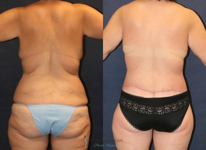 Before & After Post Weight Loss Case 9354 Back View in Portage, Kalamazoo, Battle Creek, Michigan