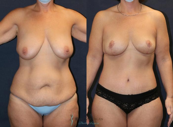Before & After Post Weight Loss Case 9354 Front View in Kalamazoo & Grand Rapids, Michigan