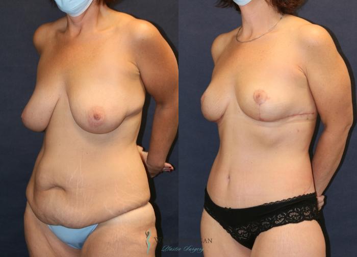 Before & After Post Weight Loss Case 9354 Left Oblique View in Portage, Kalamazoo, Battle Creek, Michigan