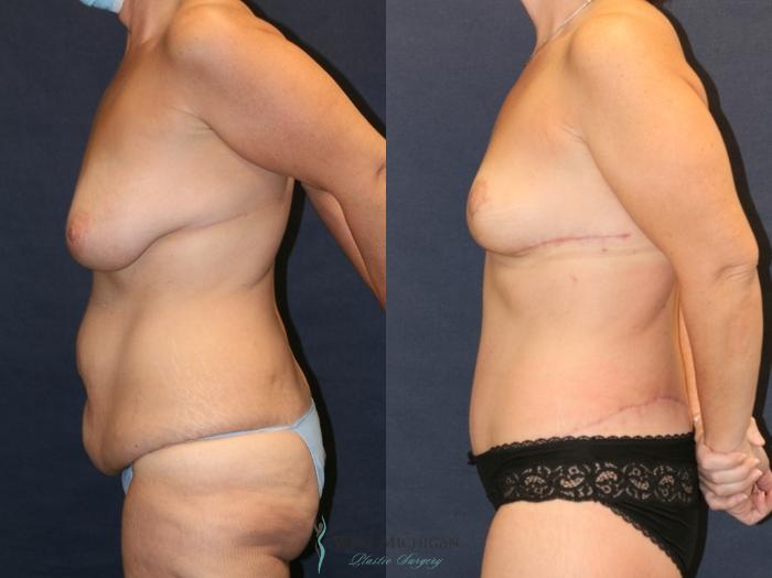 Before & After Post Weight Loss Case 9354 Left Side View in Portage, Kalamazoo, Battle Creek, Michigan