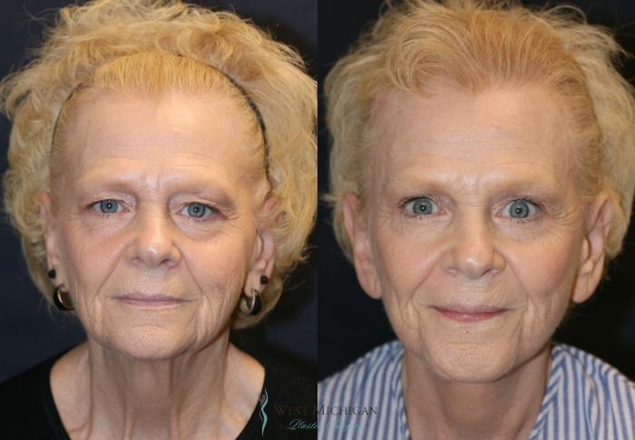 Before & After Brow Lift Case 9355 Front View in Portage, Kalamazoo, Battle Creek, Michigan