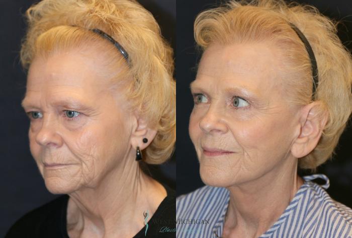 Before & After Brow Lift Case 9355 Left Oblique View in Portage, Kalamazoo, Battle Creek, Michigan