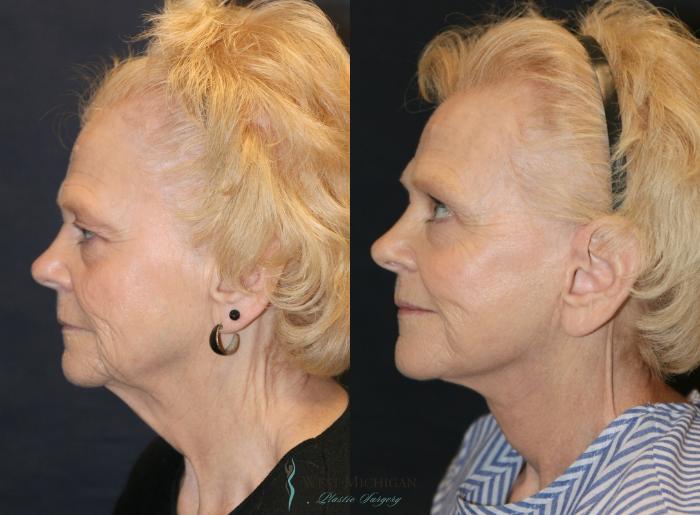 Before & After Facelift Case 9355 Left Side View in Kalamazoo & Grand Rapids, Michigan