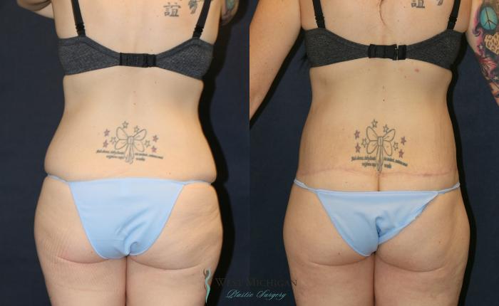 Before & After Post Weight Loss Case 9380 Back View in Portage, Kalamazoo, Battle Creek, Michigan