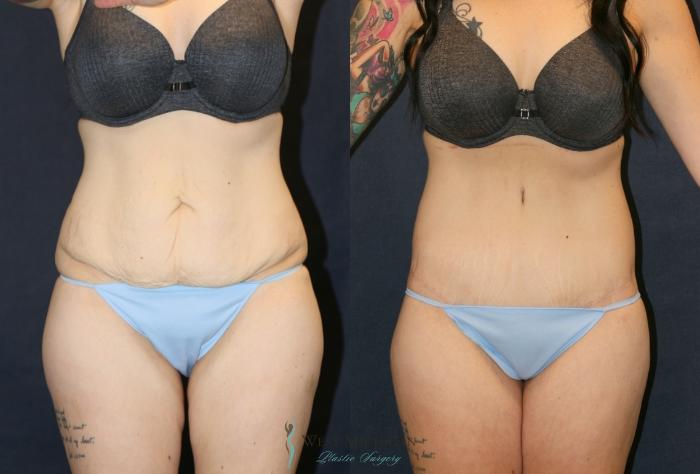 Before & After Post Weight Loss Case 9380 Front View in Portage, Kalamazoo, Battle Creek, Michigan