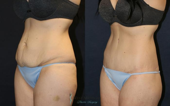 Before & After Post Weight Loss Case 9380 Left Oblique View in Kalamazoo & Grand Rapids, Michigan