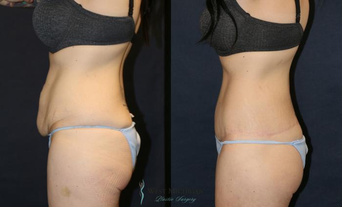 Before & After Post Weight Loss Case 9380 Left Side View in Portage, Kalamazoo, Battle Creek, Michigan