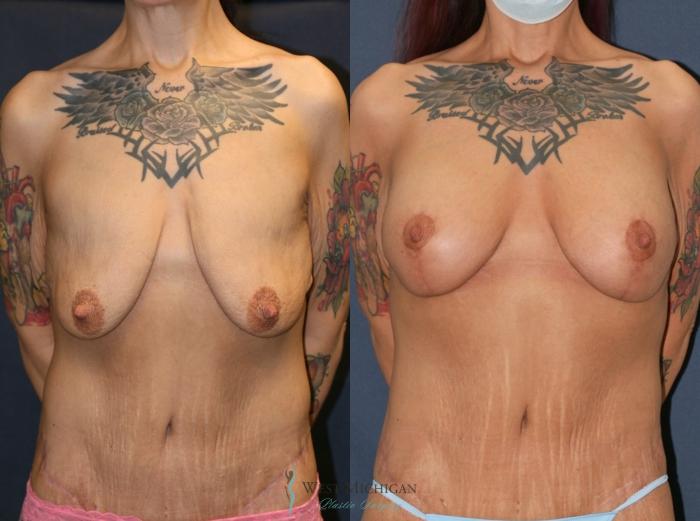 Before & After Post Weight Loss Case 9382 Front View in Kalamazoo & Grand Rapids, Michigan