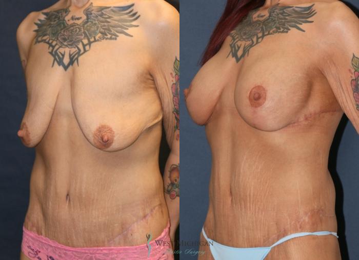 Before & After Post Weight Loss Case 9382 Left Oblique View in Portage, Kalamazoo, Battle Creek, Michigan