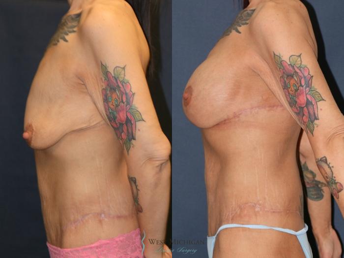Before & After Post Weight Loss Case 9382 Left Side View in Portage, Kalamazoo, Battle Creek, Michigan
