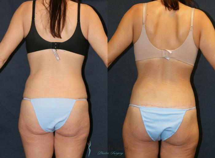 Before & After Post Weight Loss Case 9383 Back View in Portage, Kalamazoo, Battle Creek, Michigan