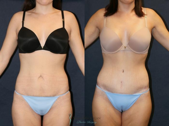 Before & After Post Weight Loss Case 9383 Front View in Portage, Kalamazoo, Battle Creek, Michigan