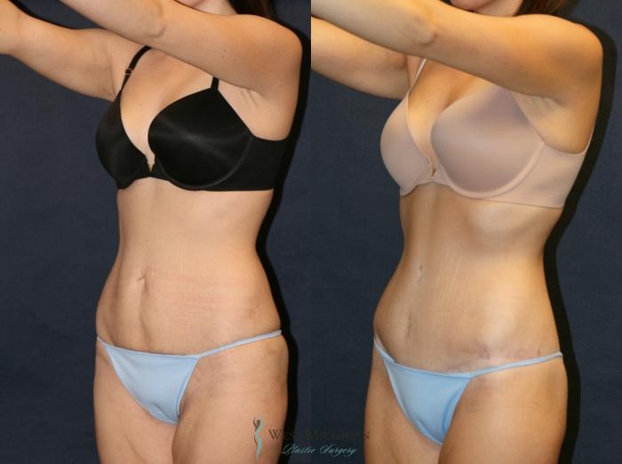 Before & After Post Weight Loss Case 9383 Left Oblique View in Kalamazoo & Grand Rapids, Michigan