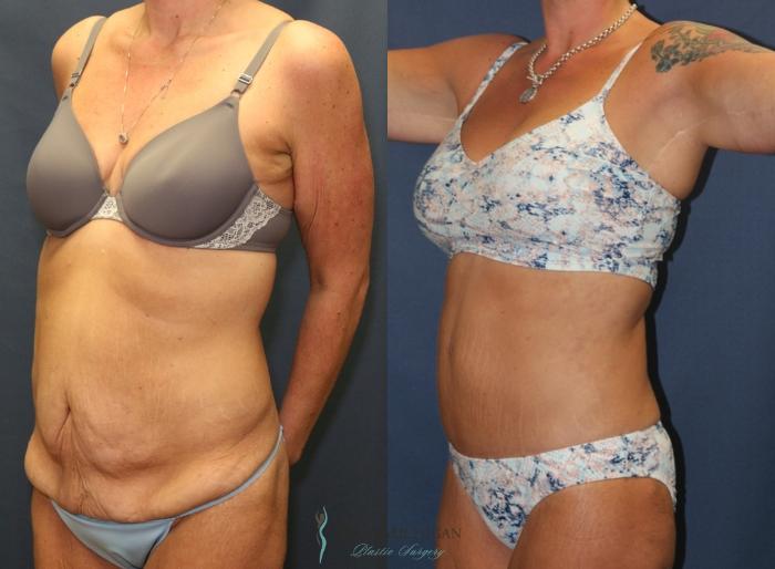 Before & After Post Weight Loss Case 9384 Left Oblique View in Kalamazoo & Grand Rapids, Michigan