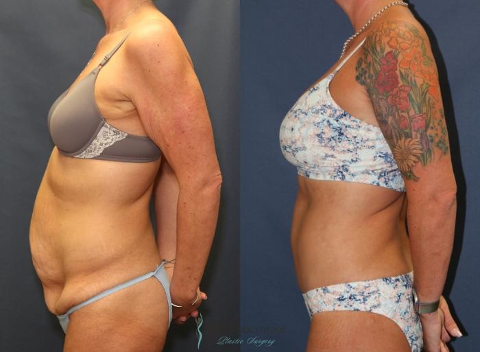 Before & After Post Weight Loss Case 9384 Left Side View in Portage, Kalamazoo, Battle Creek, Michigan