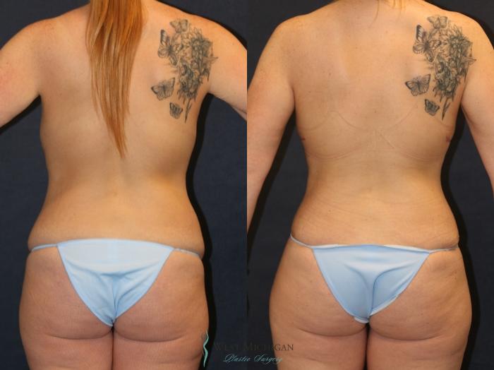 Before & After Post Weight Loss Case 9385 Back View in Portage, Kalamazoo, Battle Creek, Michigan