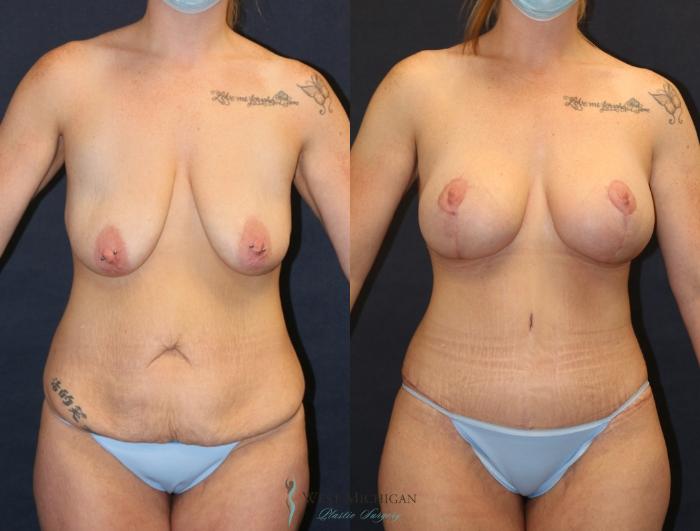 Before & After Post Weight Loss Case 9385 Front View in Portage, Kalamazoo, Battle Creek, Michigan