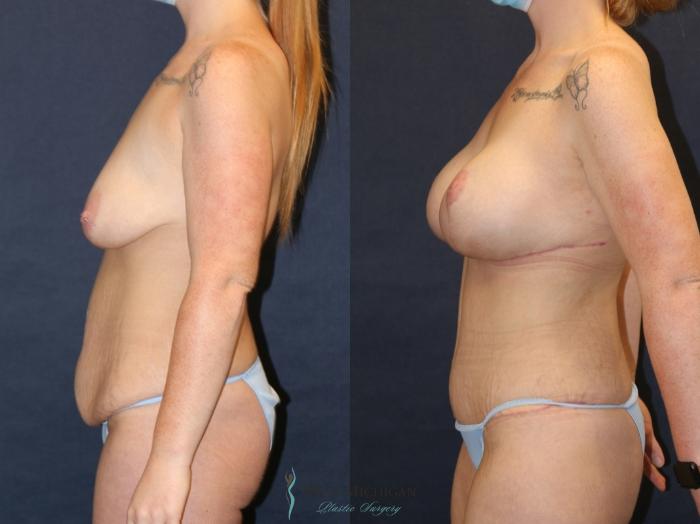 Before & After Post Weight Loss Case 9385 Left Side View in Portage, Kalamazoo, Battle Creek, Michigan