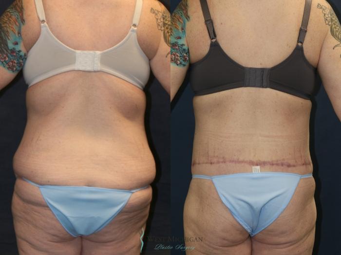 Before & After Post Weight Loss Case 9386 Back View in Portage, Kalamazoo, Battle Creek, Michigan