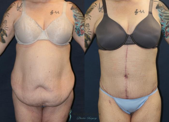Before & After Post Weight Loss Case 9386 Front View in Portage, Kalamazoo, Battle Creek, Michigan