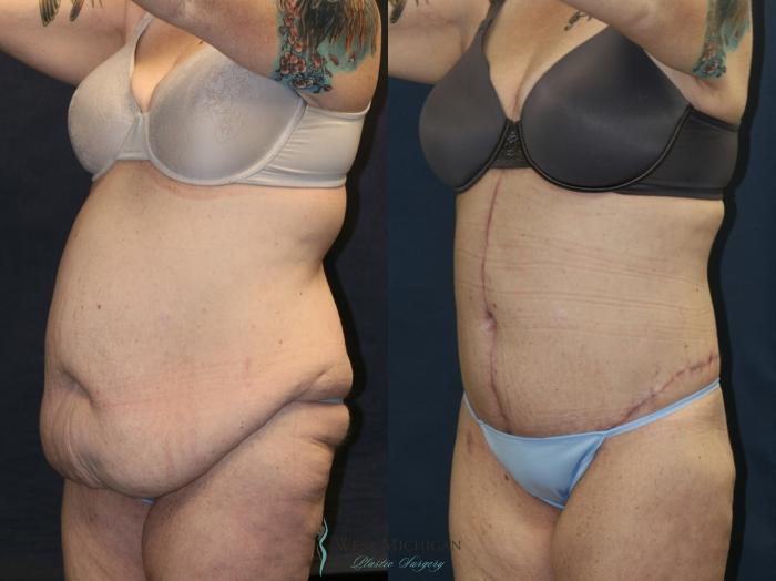 Before & After Post Weight Loss Case 9386 Left Oblique View in Kalamazoo & Grand Rapids, Michigan