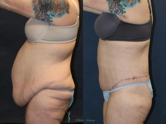Before & After Post Weight Loss Case 9386 Left Side View in Portage, Kalamazoo, Battle Creek, Michigan