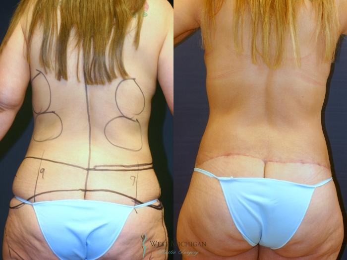 Before & After Post Weight Loss Case 9392 Back View in Portage, Kalamazoo, Battle Creek, Michigan