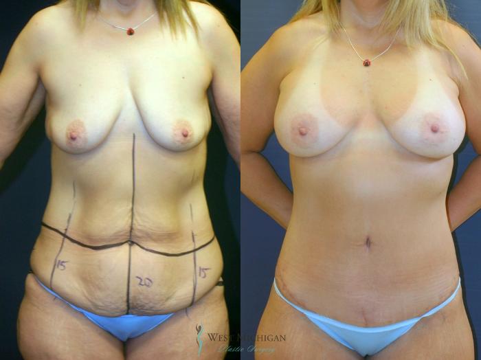Before & After Post Weight Loss Case 9392 Front View in Portage, Kalamazoo, Battle Creek, Michigan
