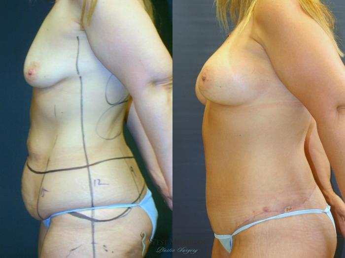 Before & After Post Weight Loss Case 9392 Left Side View in Portage, Kalamazoo, Battle Creek, Michigan