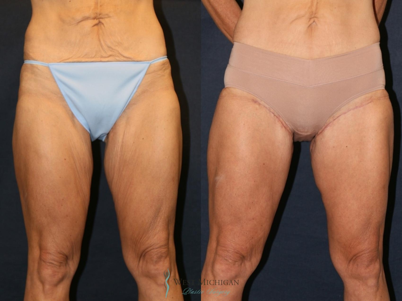 Before & After Thigh Lift Case 9328 Front View in Portage, Kalamazoo, Battle Creek, Michigan