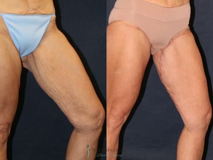 Before & After Thigh Lift Case 9328 Left Side View in Portage, Kalamazoo, Battle Creek, Michigan