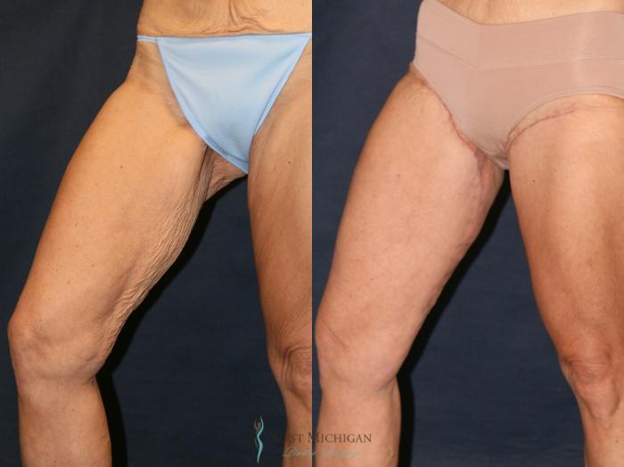 Before & After Thigh Lift Case 9328 Right Side View in Portage, Kalamazoo, Battle Creek, Michigan