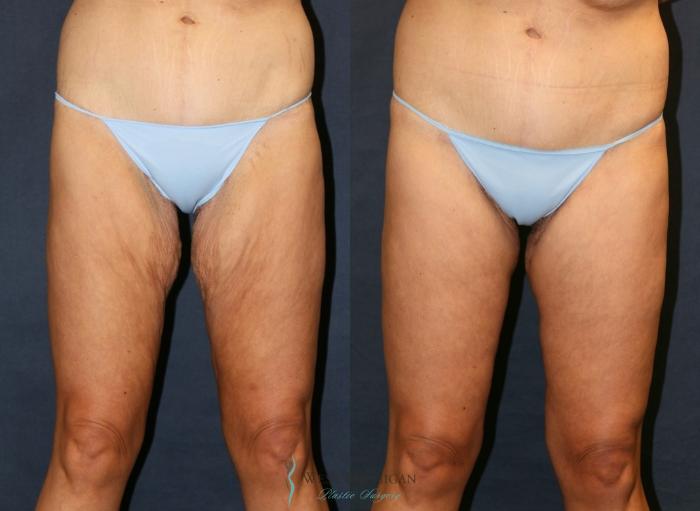 Before & After Thigh Lift Case 9381 Front View in Portage, Kalamazoo, Battle Creek, Michigan