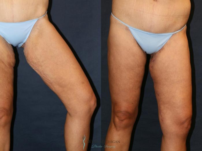 Before & After Thigh Lift Case 9381 Left Side View in Kalamazoo & Grand Rapids, Michigan