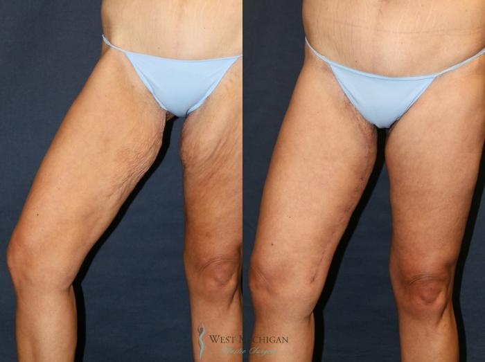 Before & After Thigh Lift Case 9381 Right Side View in Kalamazoo & Grand Rapids, Michigan