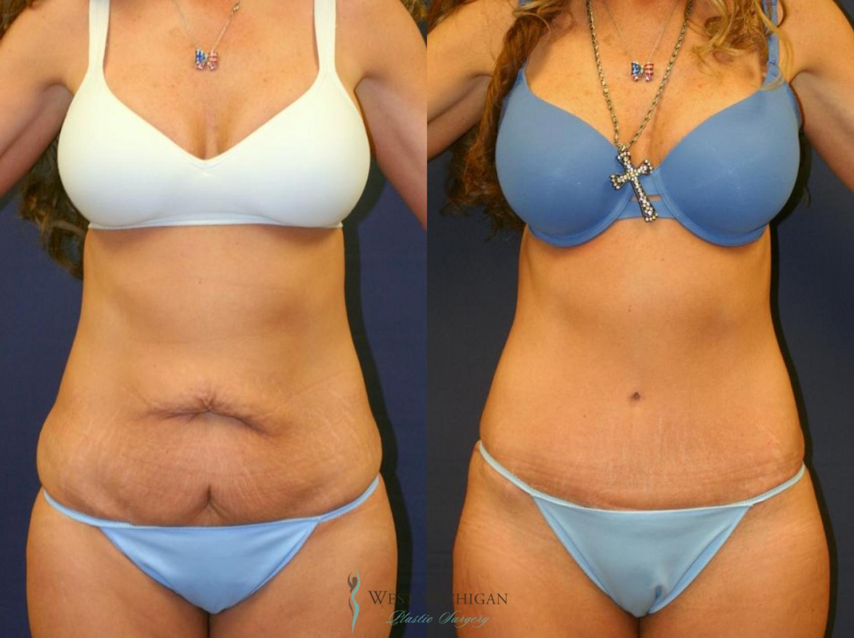 Before & After Tummy Tuck Case 8744 View #1 View in Portage, Kalamazoo, Battle Creek, Michigan