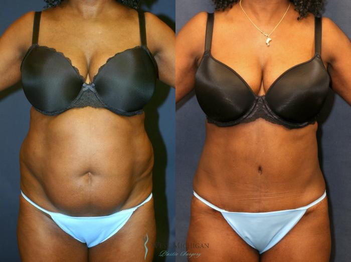 Before & After Tummy Tuck Case 8969 View #1 View in Kalamazoo & Grand Rapids, Michigan