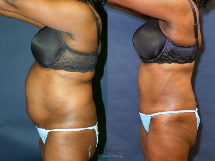 Before & After Tummy Tuck Case 8969 View #2 View in Kalamazoo & Grand Rapids, Michigan