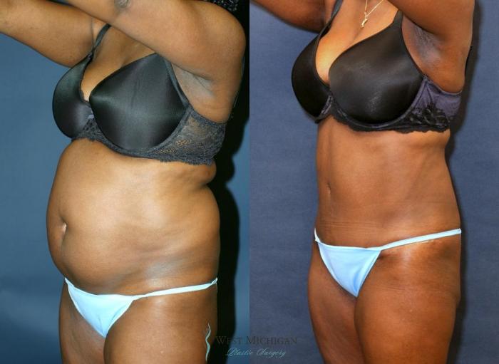 Before & After Tummy Tuck Case 8969 View #3 View in Kalamazoo & Grand Rapids, Michigan