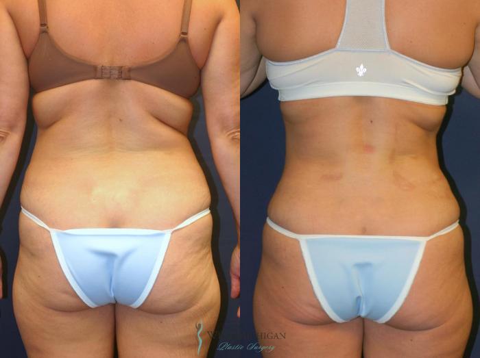 Before & After Tummy Tuck Case 8970 View #3 View in Portage, Kalamazoo, Battle Creek, Michigan