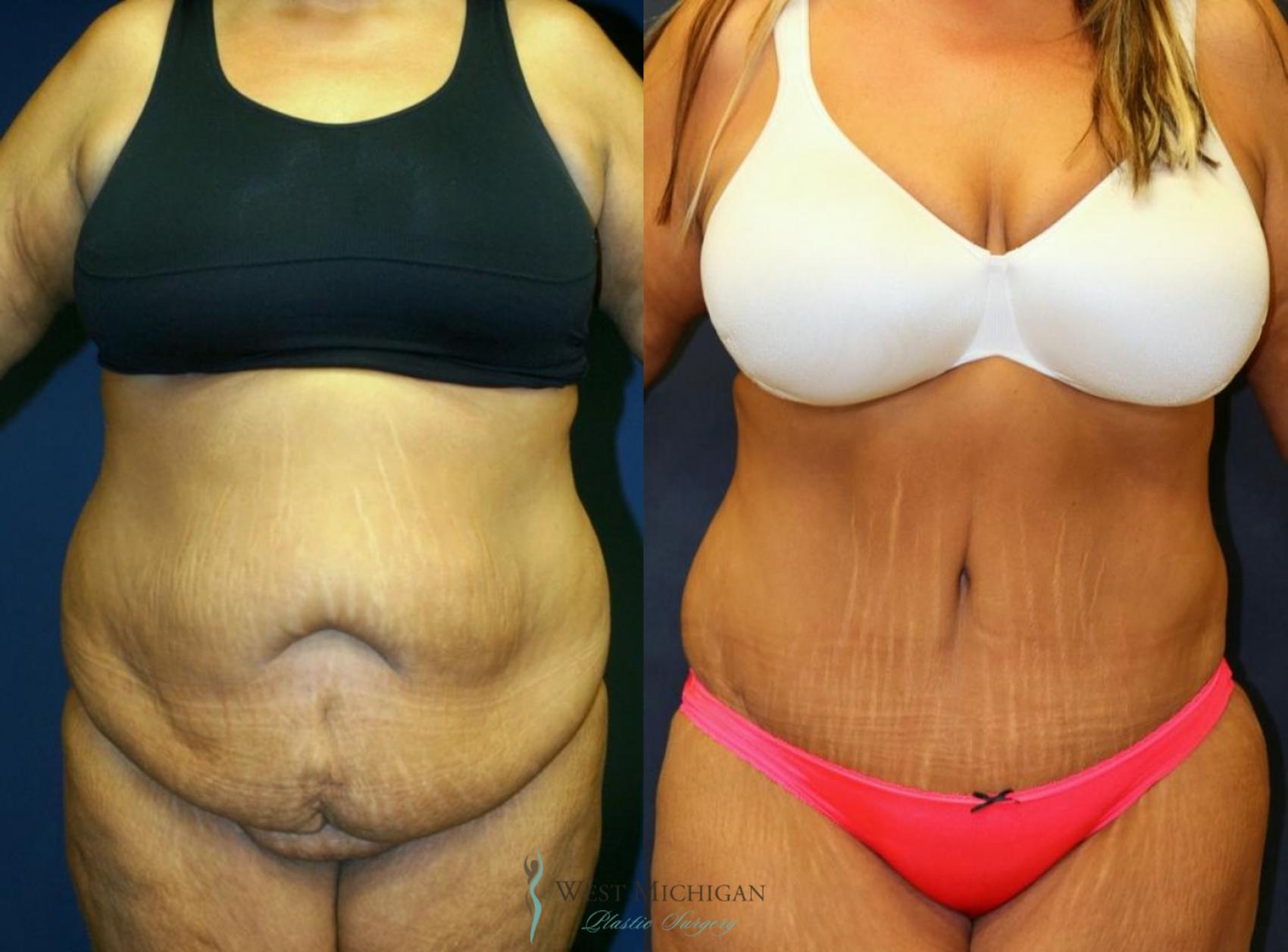 Before & After Tummy Tuck Case 8971 View #1 View in Kalamazoo & Grand Rapids, Michigan