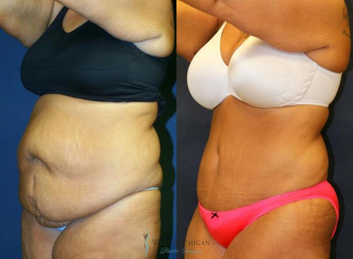 Before & After Tummy Tuck Case 8971 View #3 View in Kalamazoo & Grand Rapids, Michigan