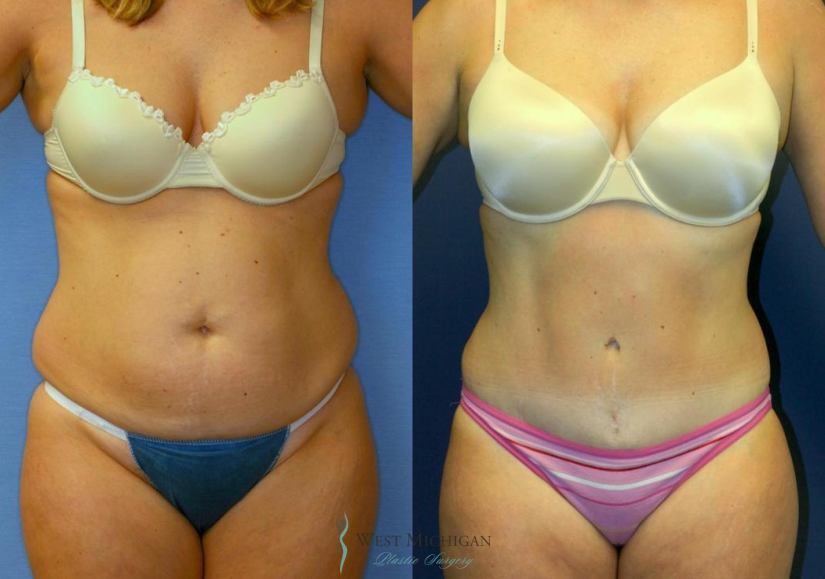 Before & After Tummy Tuck Case 8972 View #1 View in Kalamazoo & Grand Rapids, Michigan