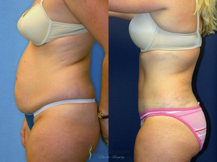 Before & After Liposuction Case 8972 View #2 View in Portage, Kalamazoo, Battle Creek, Michigan