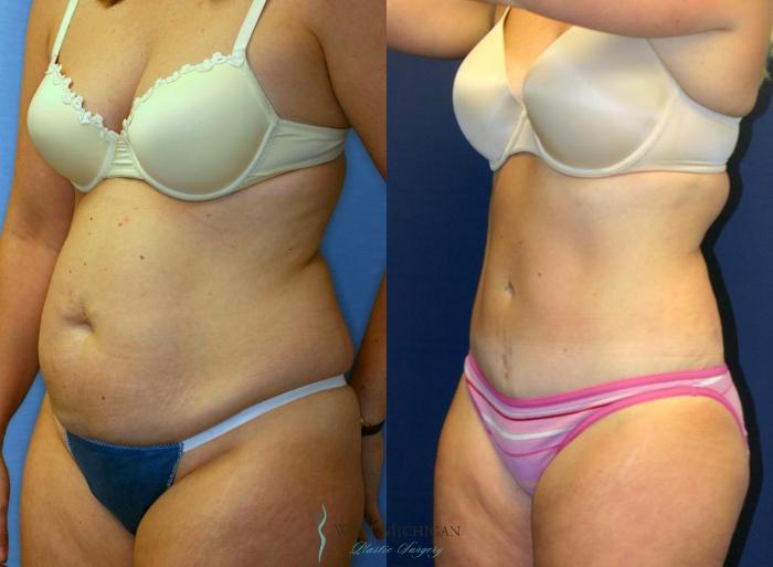 Before & After Liposuction Case 8972 View #3 View in Portage, Kalamazoo, Battle Creek, Michigan