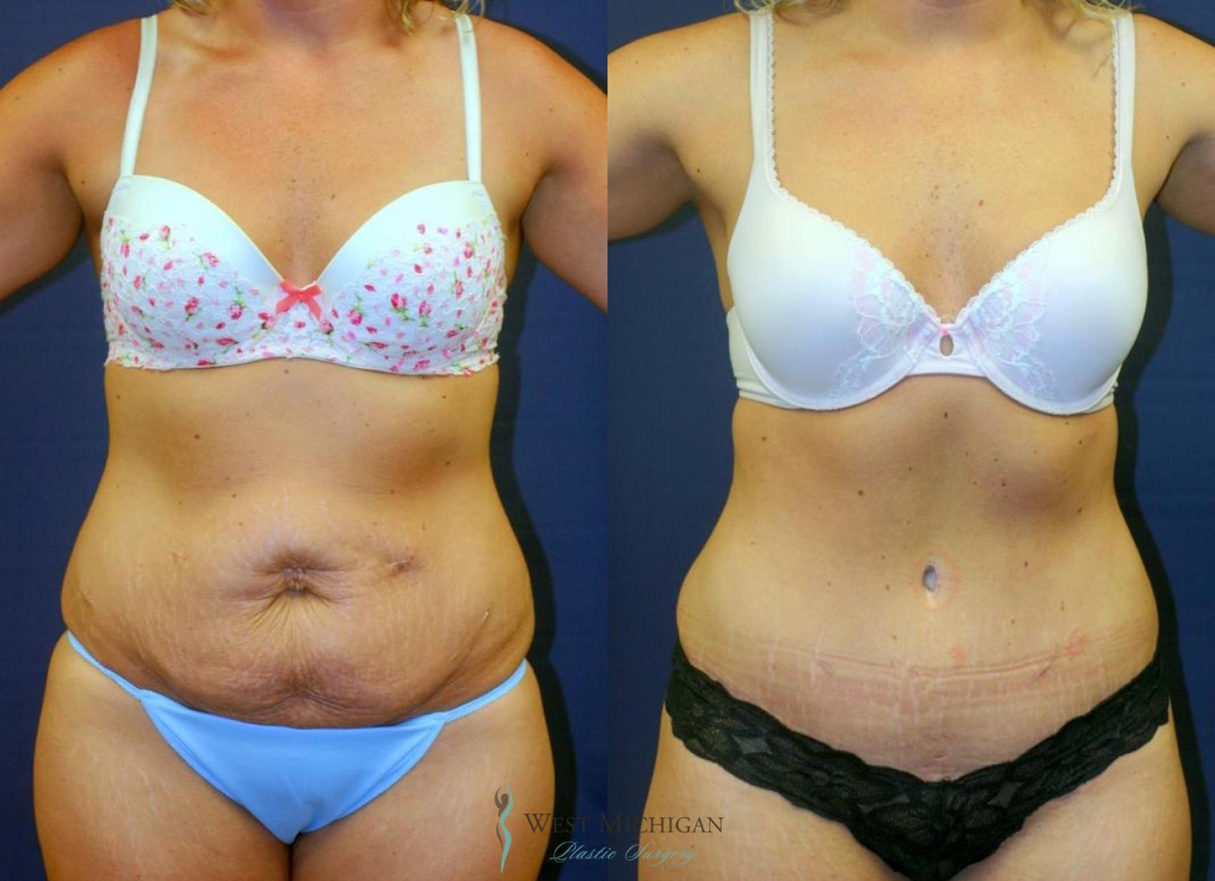 Before & After Tummy Tuck Case 8973 View #1 View in Kalamazoo & Grand Rapids, Michigan