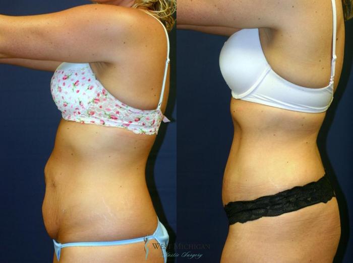 Before & After Tummy Tuck Case 8973 View #2 View in Kalamazoo & Grand Rapids, Michigan